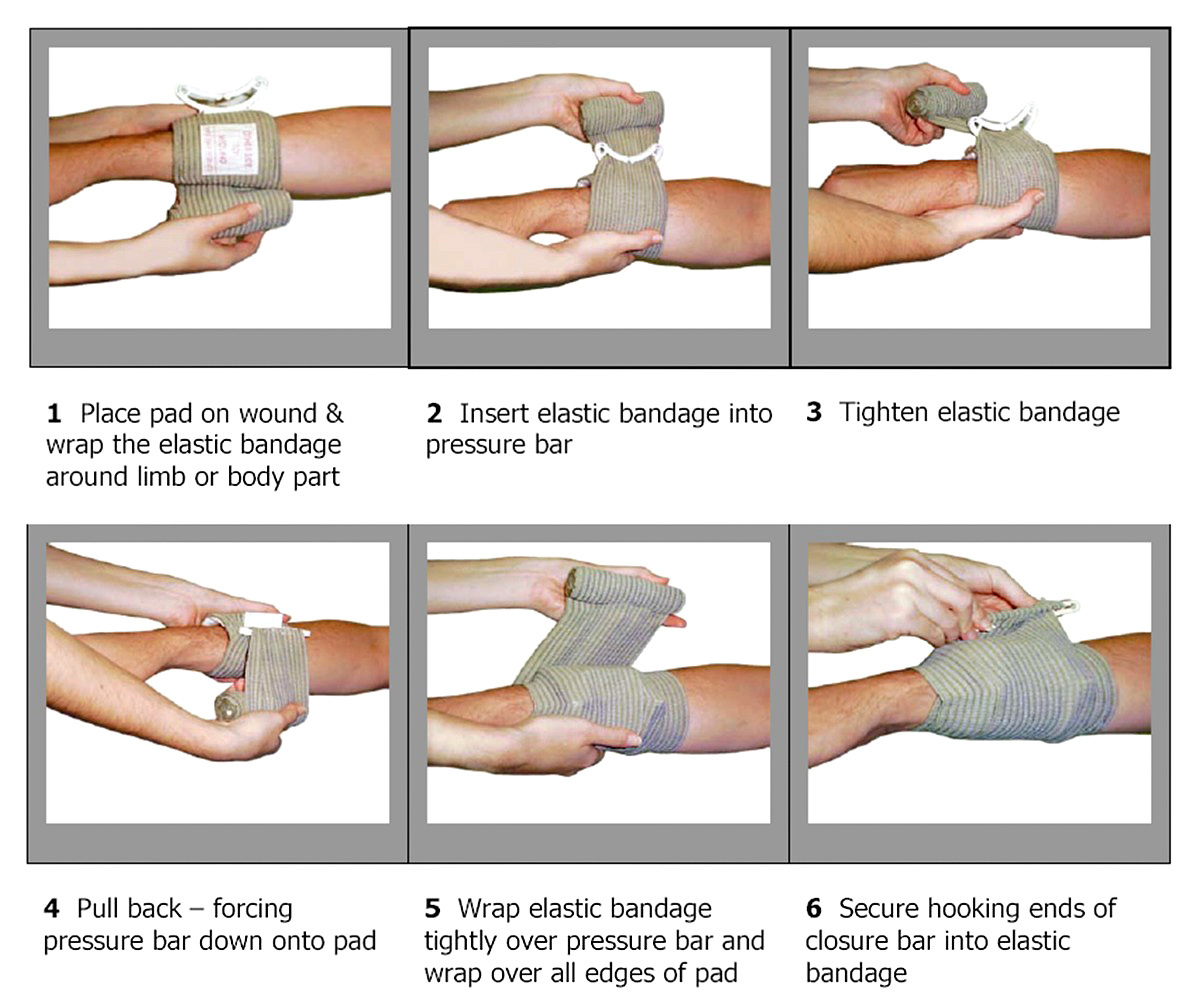 Israeli bahdage procedure